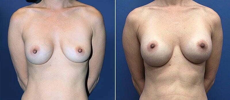 Nipple Reduction Before & After