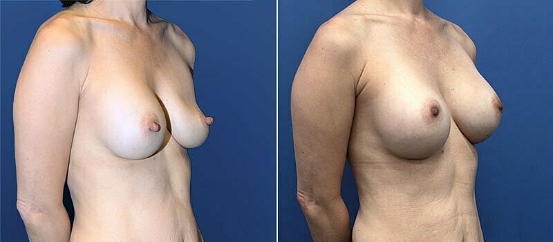 Nipple Reduction Before & After