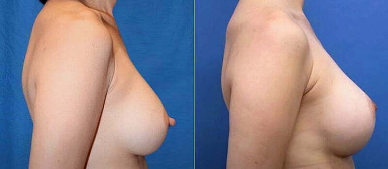 Nipple Reduction Before & After
