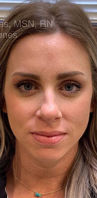 Botox Before & After