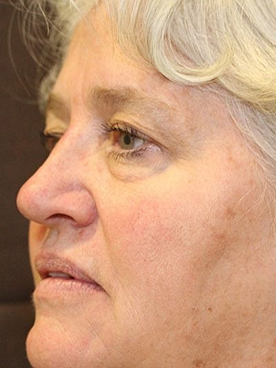 Botox Before & After