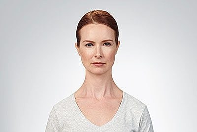 Botox Before & After