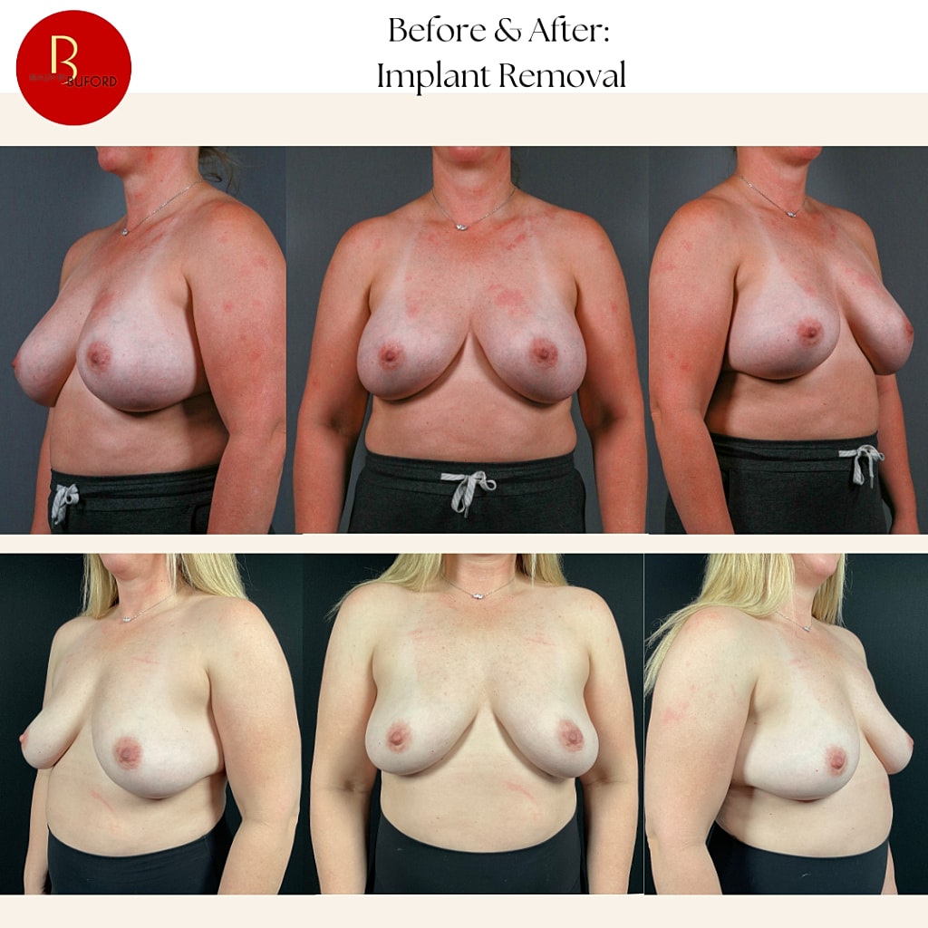 Breast Implant Removal Before & After
