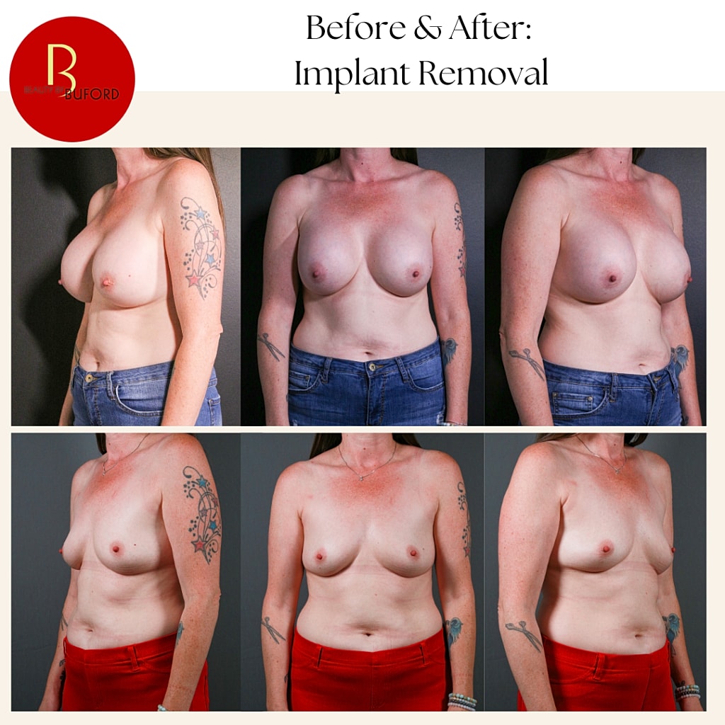 Breast Implant Removal Before & After