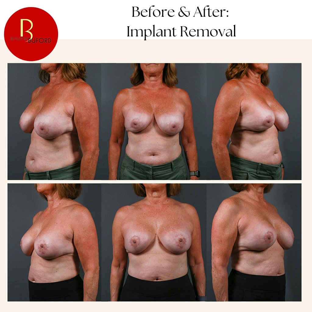Breast Implant Removal Before & After