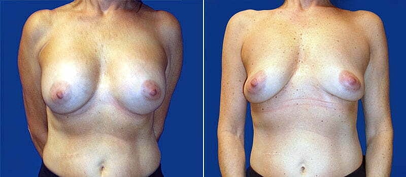 Breast Implant Removal Before & After
