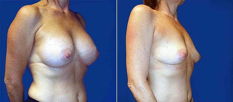 Breast Implant Removal Before & After