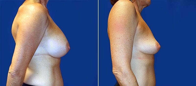 Breast Implant Removal Before & After