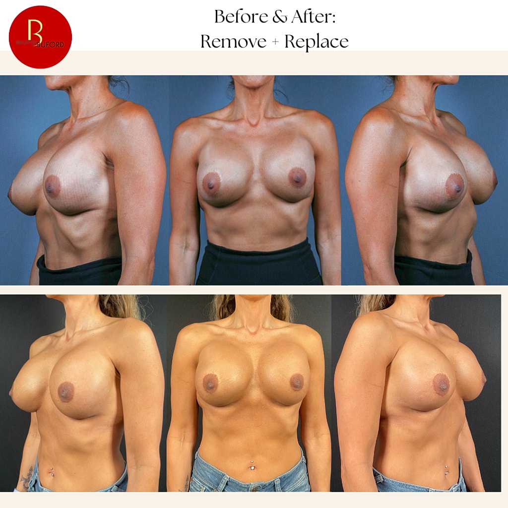 Breast Augmentation Before & After