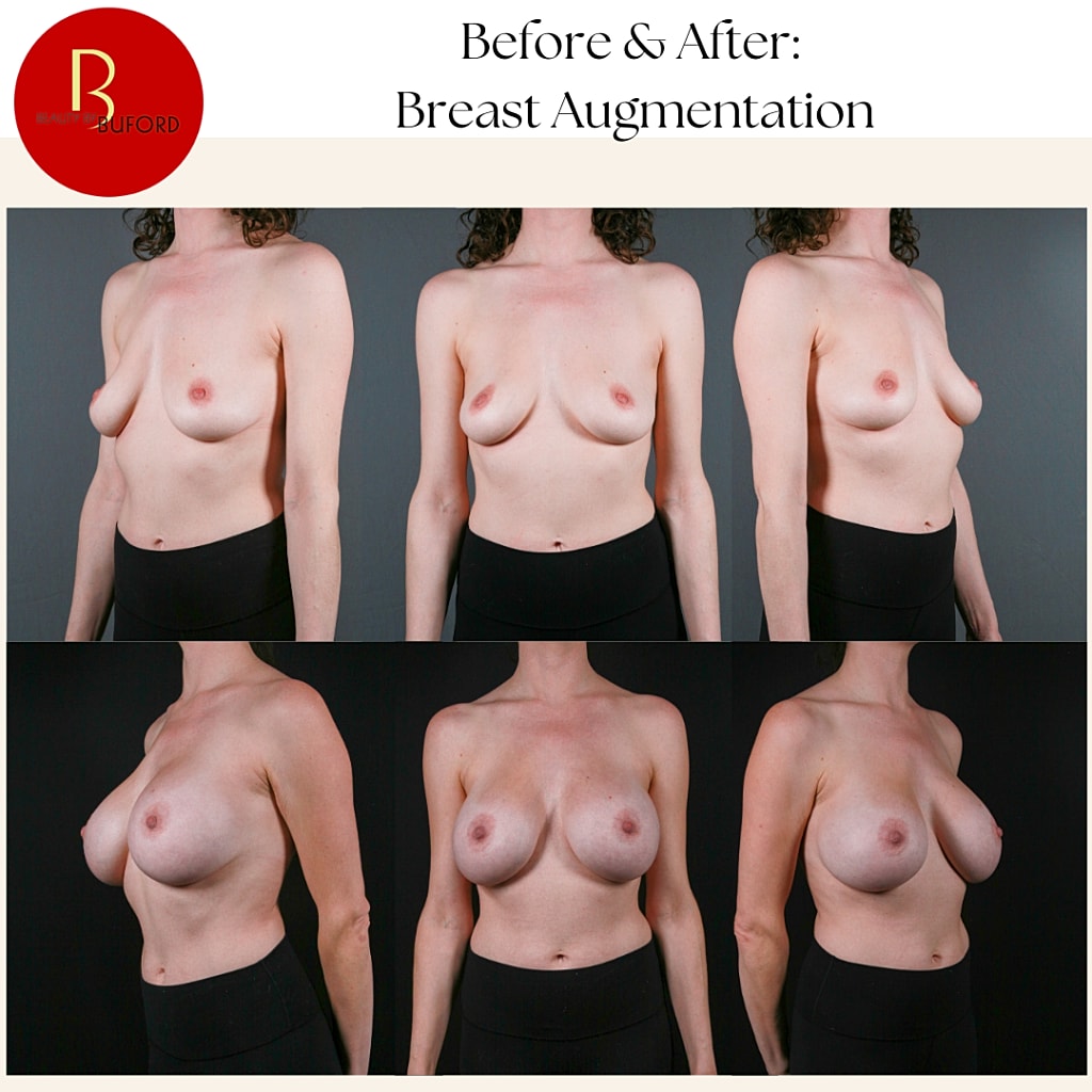 Breast Augmentation Before & After