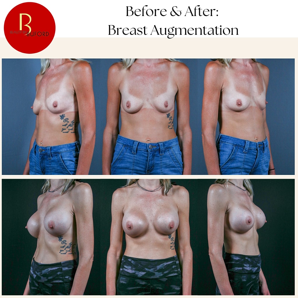 Breast Augmentation Before & After