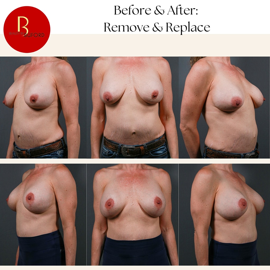 Breast Augmentation Before & After