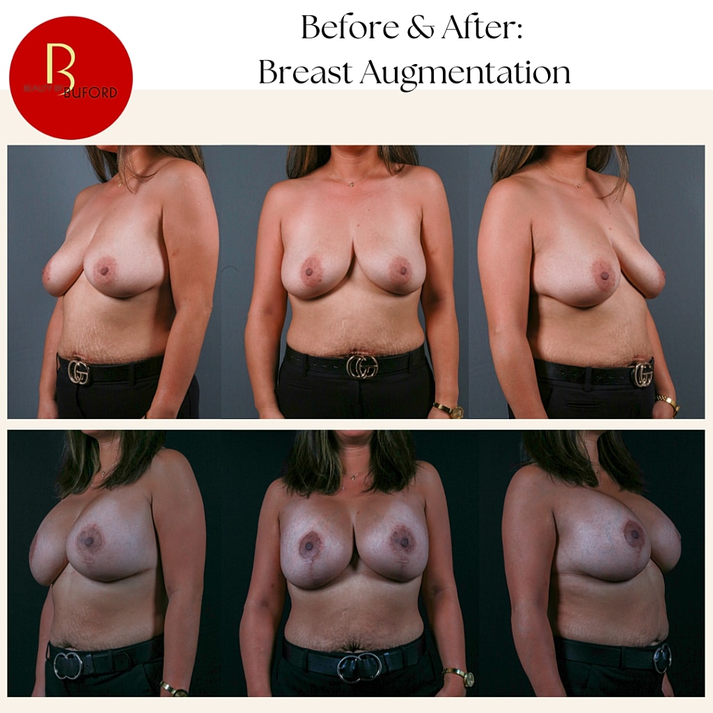 Breast Augmentation Before & After