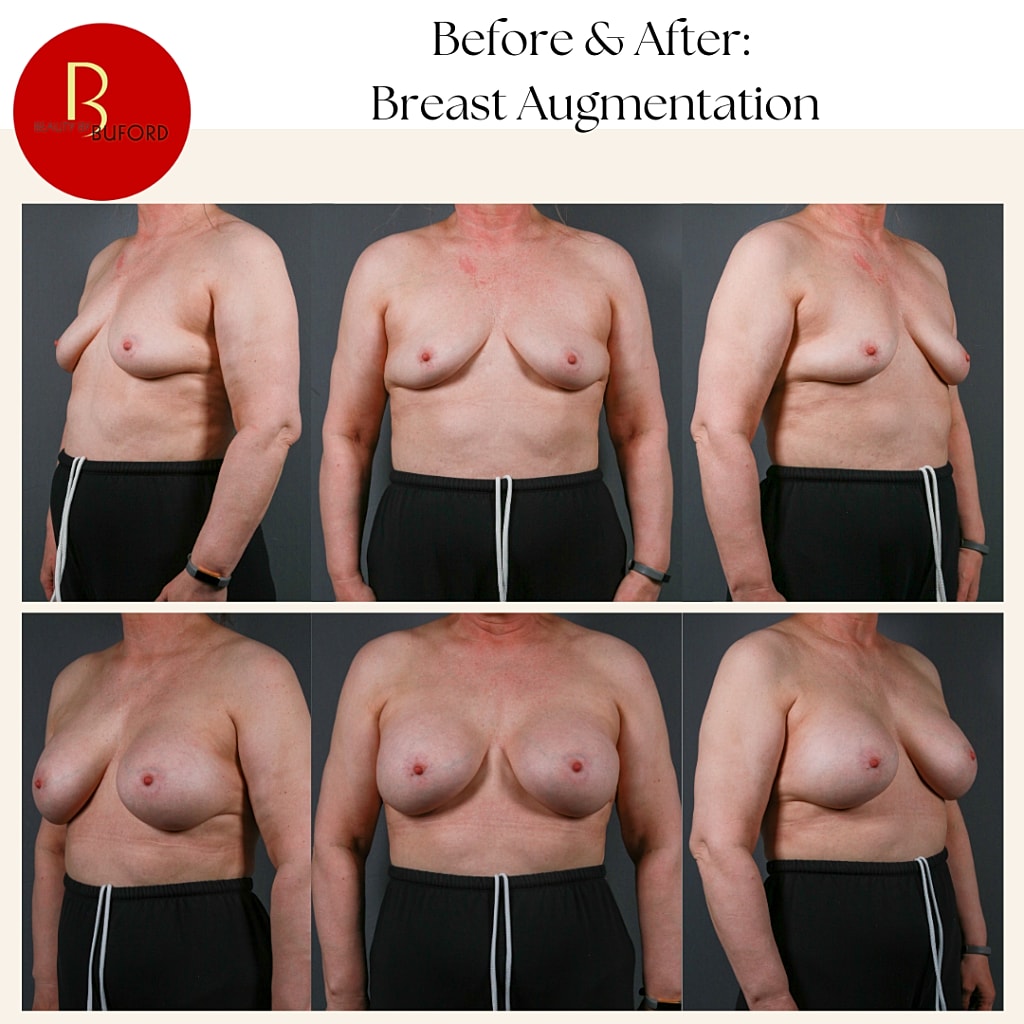 Breast Augmentation Before & After