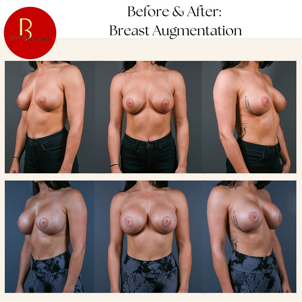 Breast Augmentation Before & After