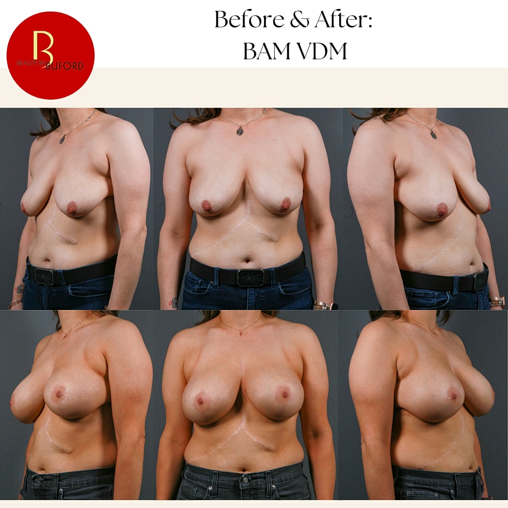 Breast Augmentation Before & After
