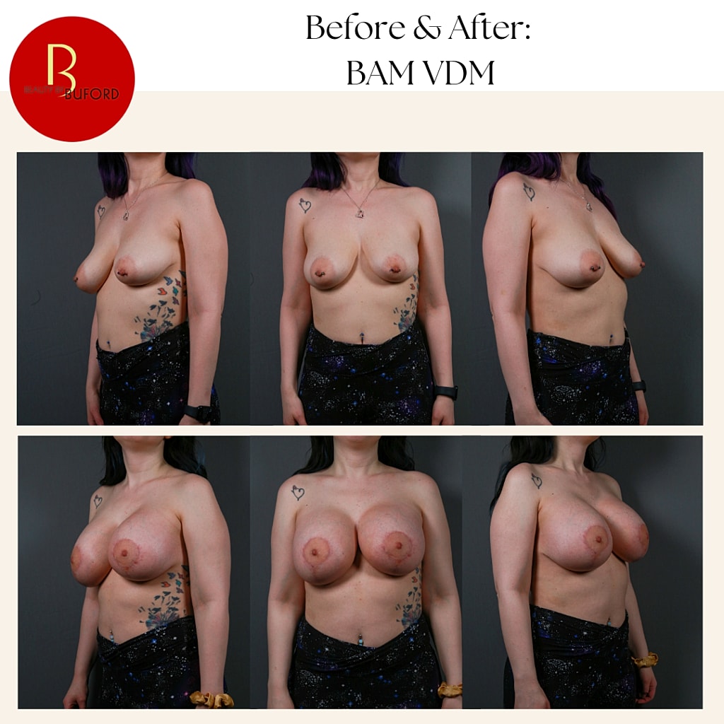 Breast Augmentation Before & After