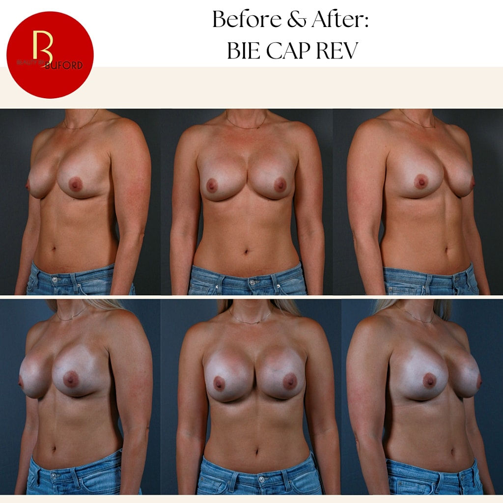 Breast Augmentation Before & After