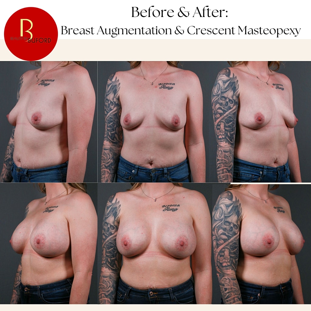 Breast Augmentation Before & After