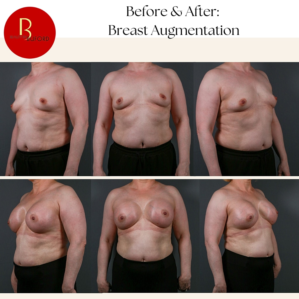 Breast Augmentation Before & After