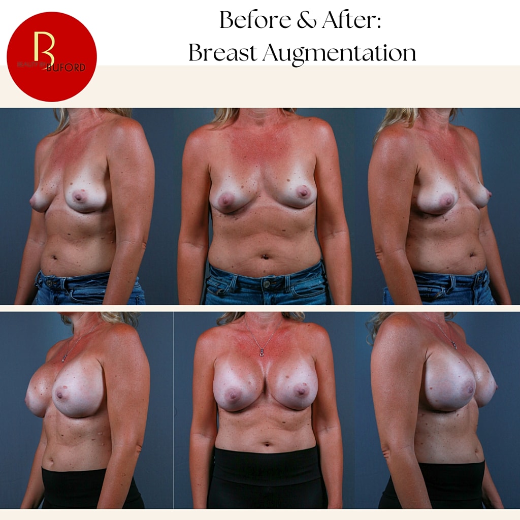 Breast Augmentation Before & After