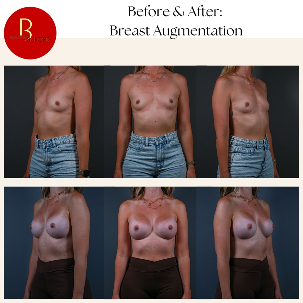 Breast Augmentation Before & After