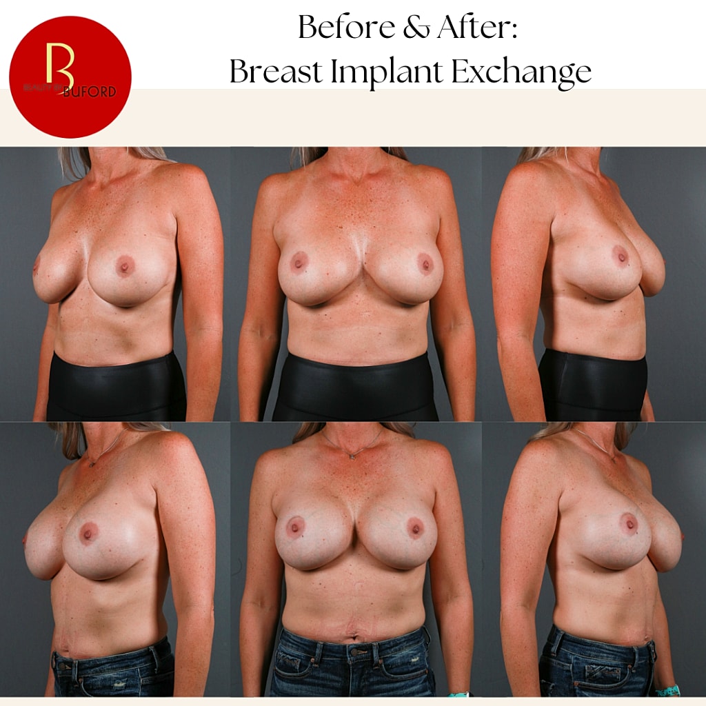 Breast Augmentation Before & After