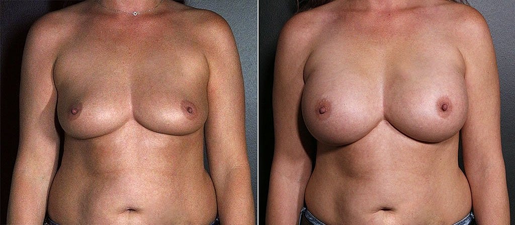 Breast Augmentation Before & After