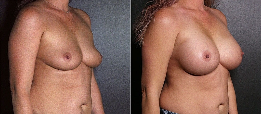 Breast Augmentation Before & After