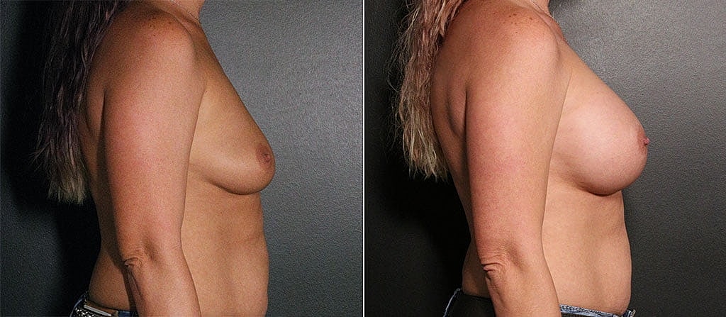 Breast Augmentation Before & After