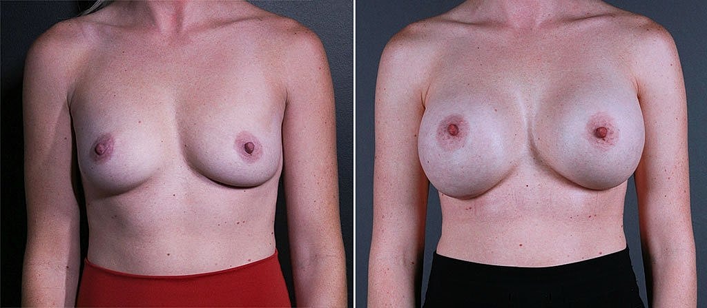 Breast Augmentation Before & After