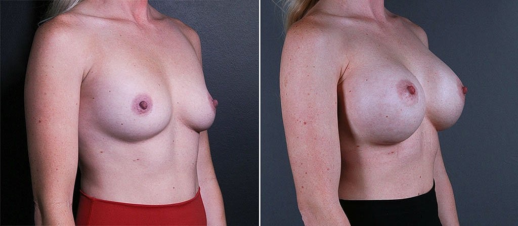Breast Augmentation Before & After
