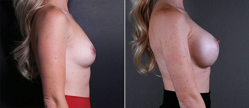 Breast Augmentation Before & After
