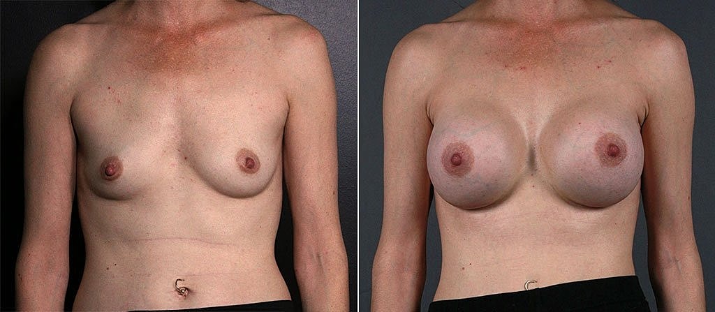 Breast Augmentation Before & After