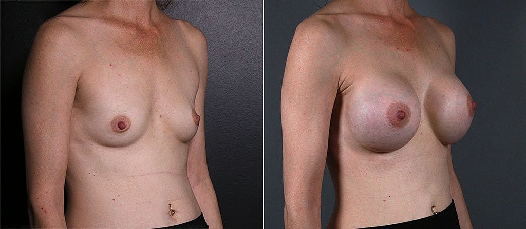 Breast Augmentation Before & After
