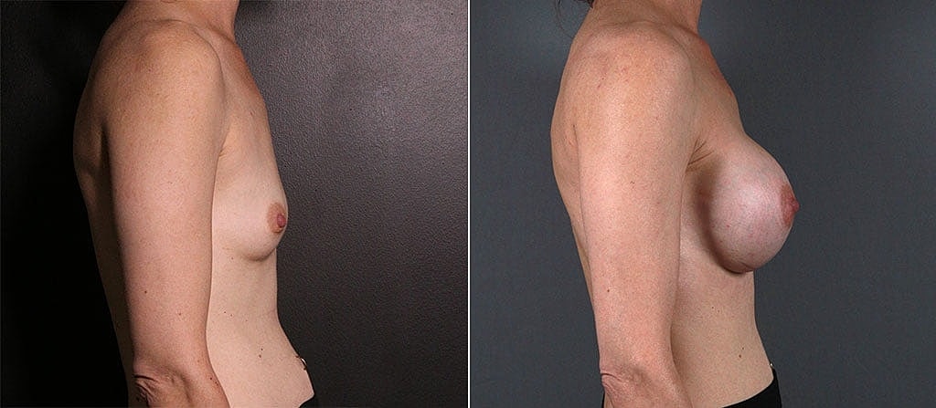 Breast Augmentation Before & After