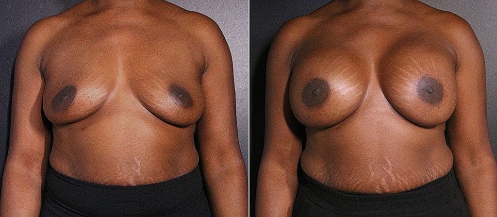 Breast Augmentation Before & After