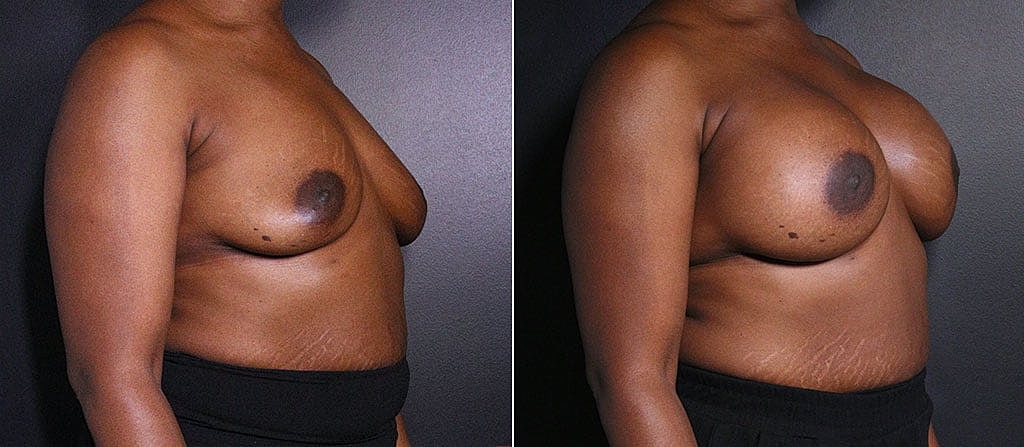 Breast Augmentation Before & After