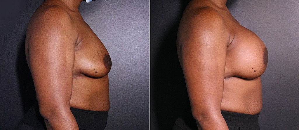 Breast Augmentation Before & After