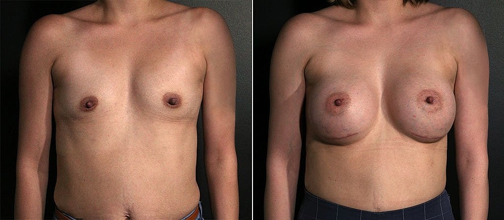 Breast Augmentation Before & After