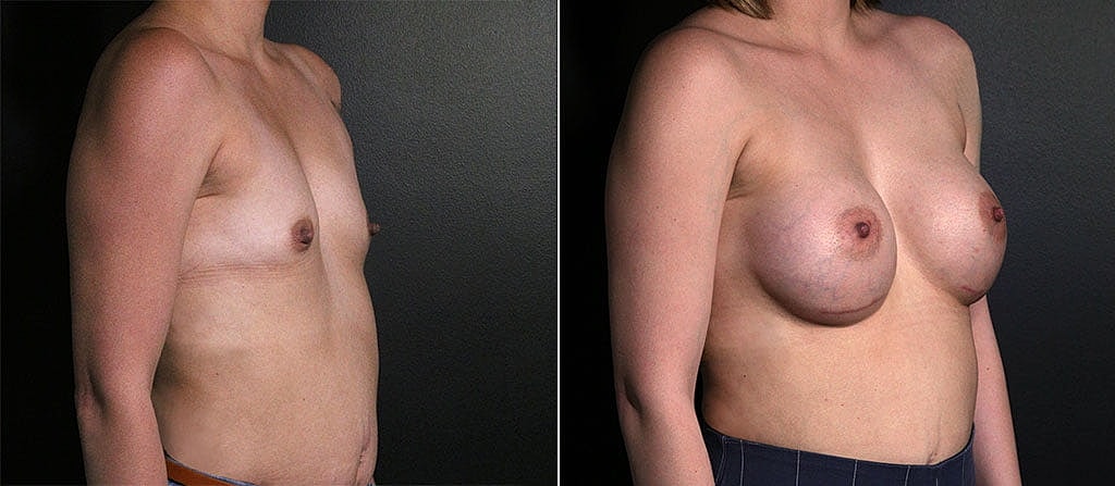 Breast Augmentation Before & After