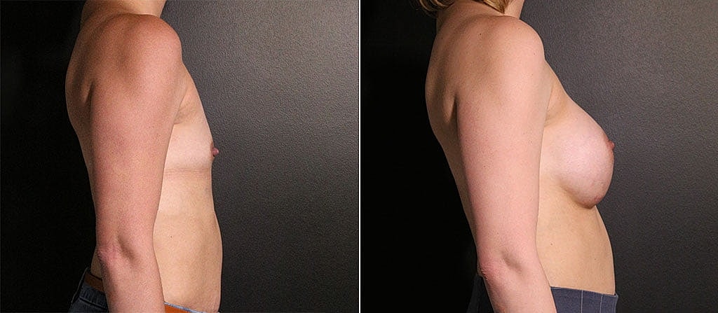 Breast Augmentation Before & After