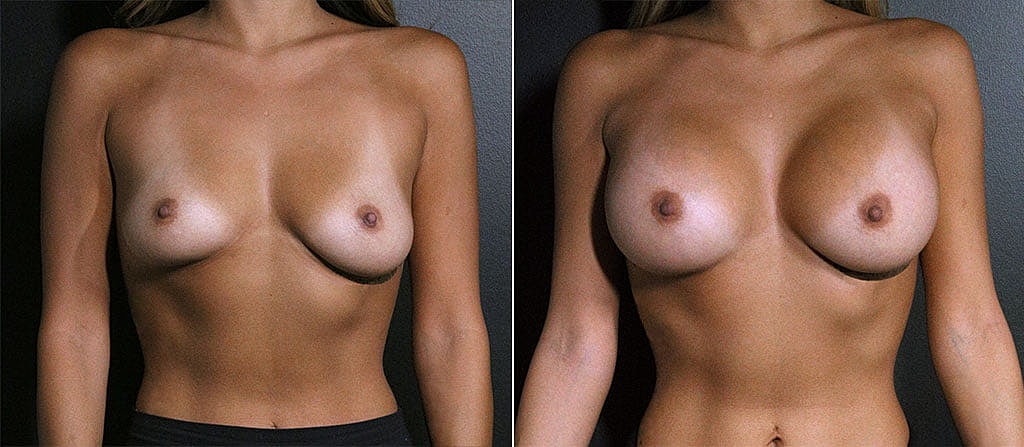Breast Augmentation Before & After