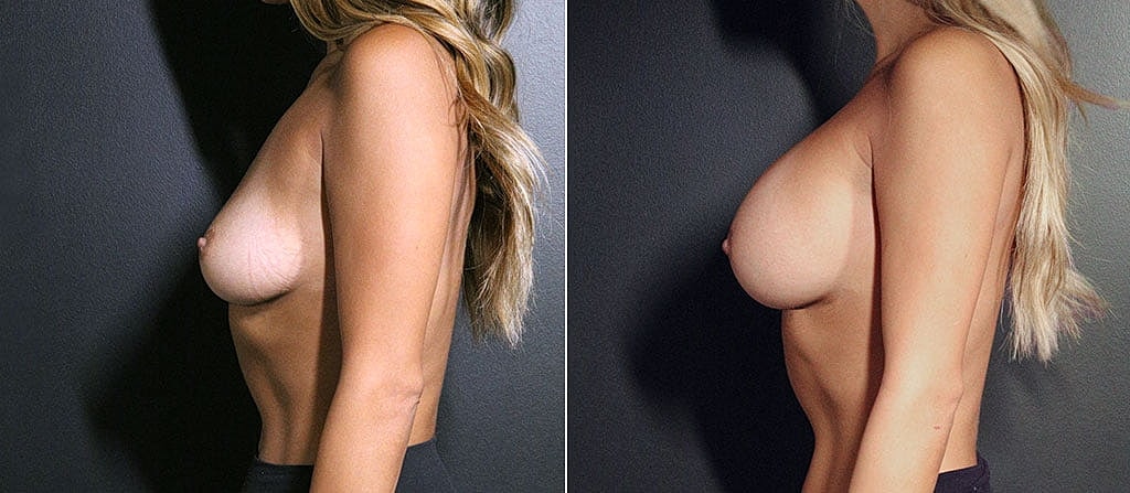 Breast Augmentation Before & After