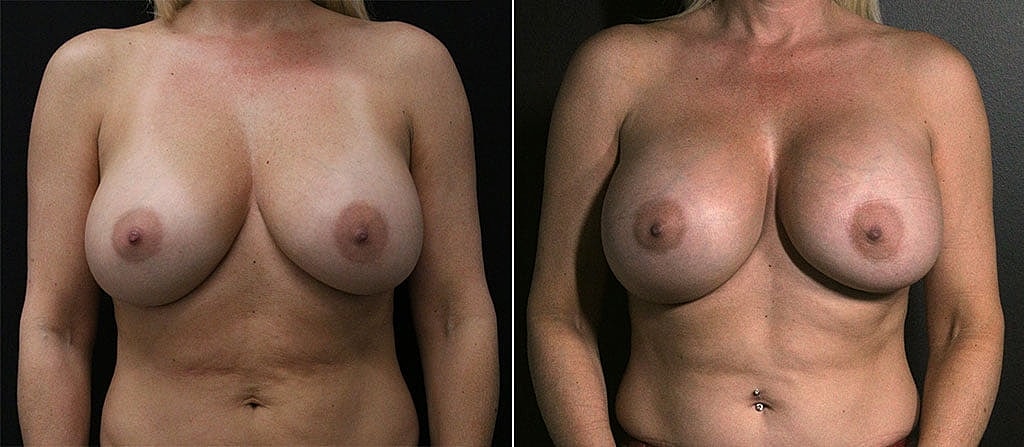 Breast Augmentation Before & After