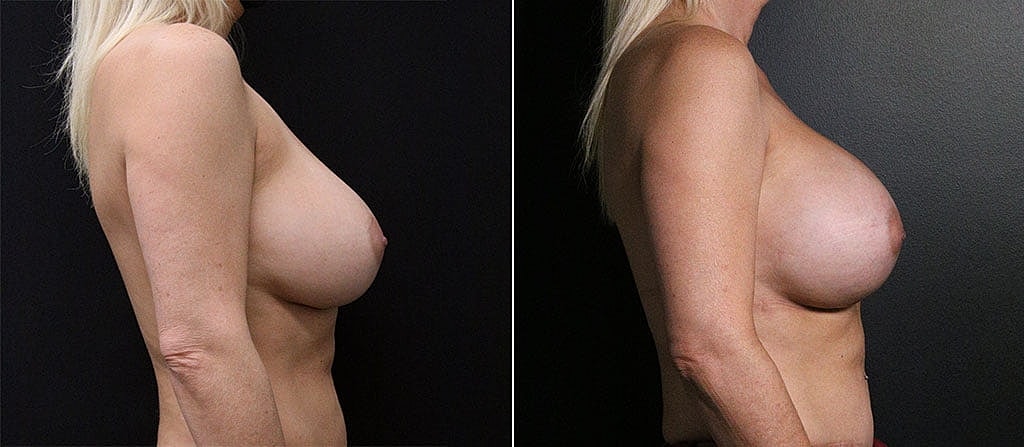 Breast Augmentation Before & After