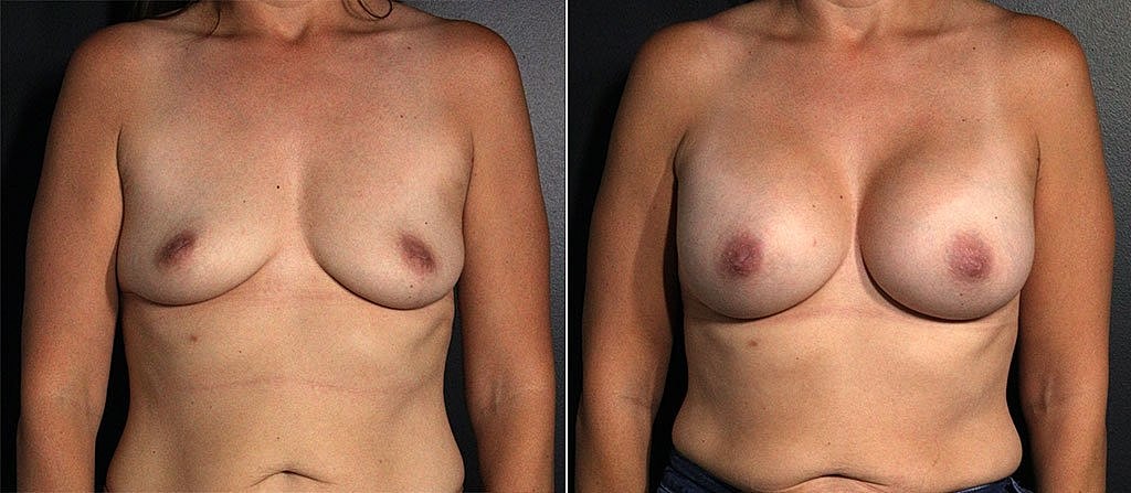 Breast Augmentation Before & After