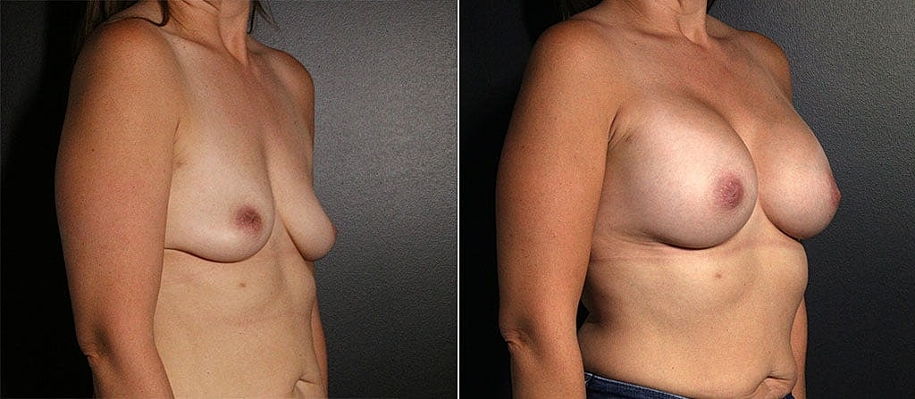 Breast Augmentation Before & After