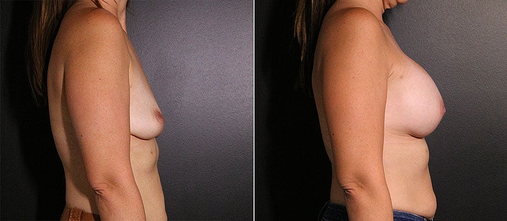 Breast Augmentation Before & After