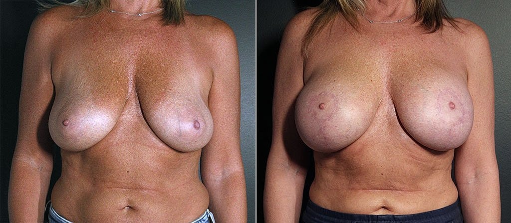 Breast Augmentation Before & After